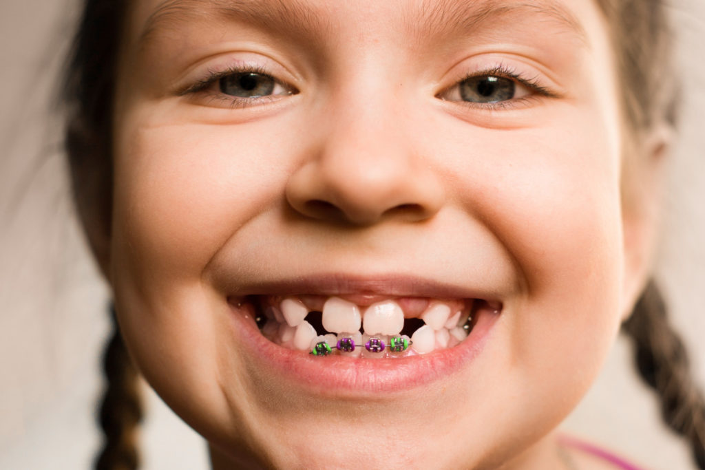 your-child-is-missing-a-permanent-tooth-children-s-dental-center